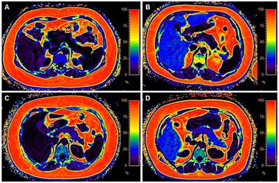 Exploring the heterogeneity of hepatic and pancreatic fat deposition in obesity: implications for metabolic health